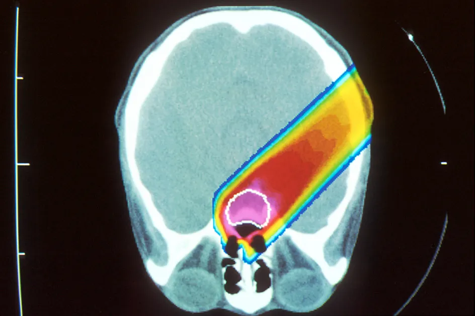 X-ray image showing tumor in red with proton beam in yellow