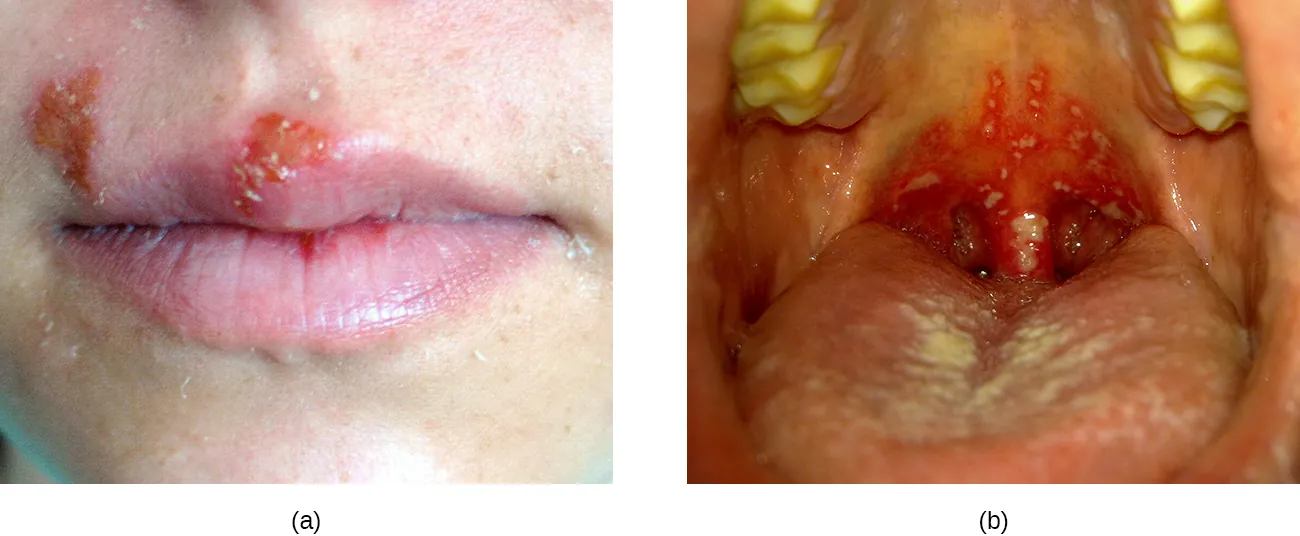 Cold sore (red bump) on the lip. Bumps are present in the back of a person's mouth.