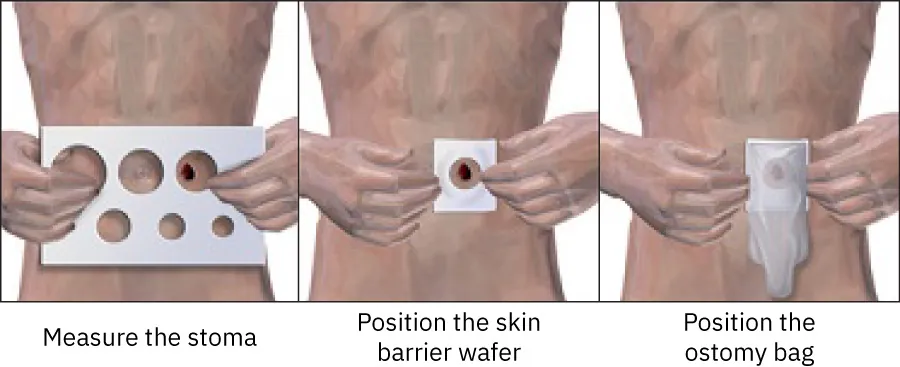 Images depicting measuring the stoma with a circle size guide, positioning the skin barrier wafer with the opening over the incision, and positioning the ostomy bag over the skin barrier.