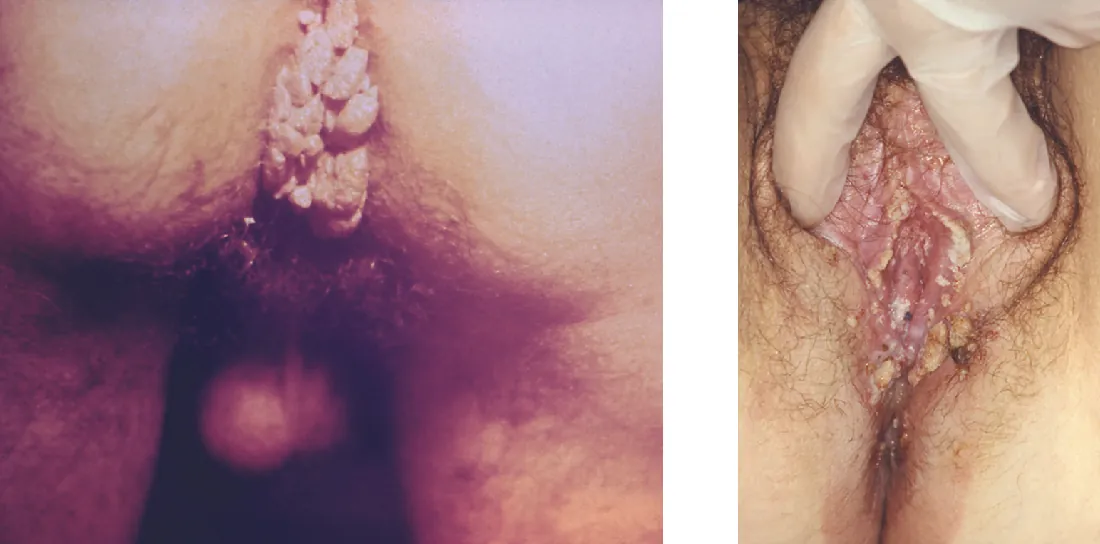 Lumpy protrusions in the anus and vaginal regions.