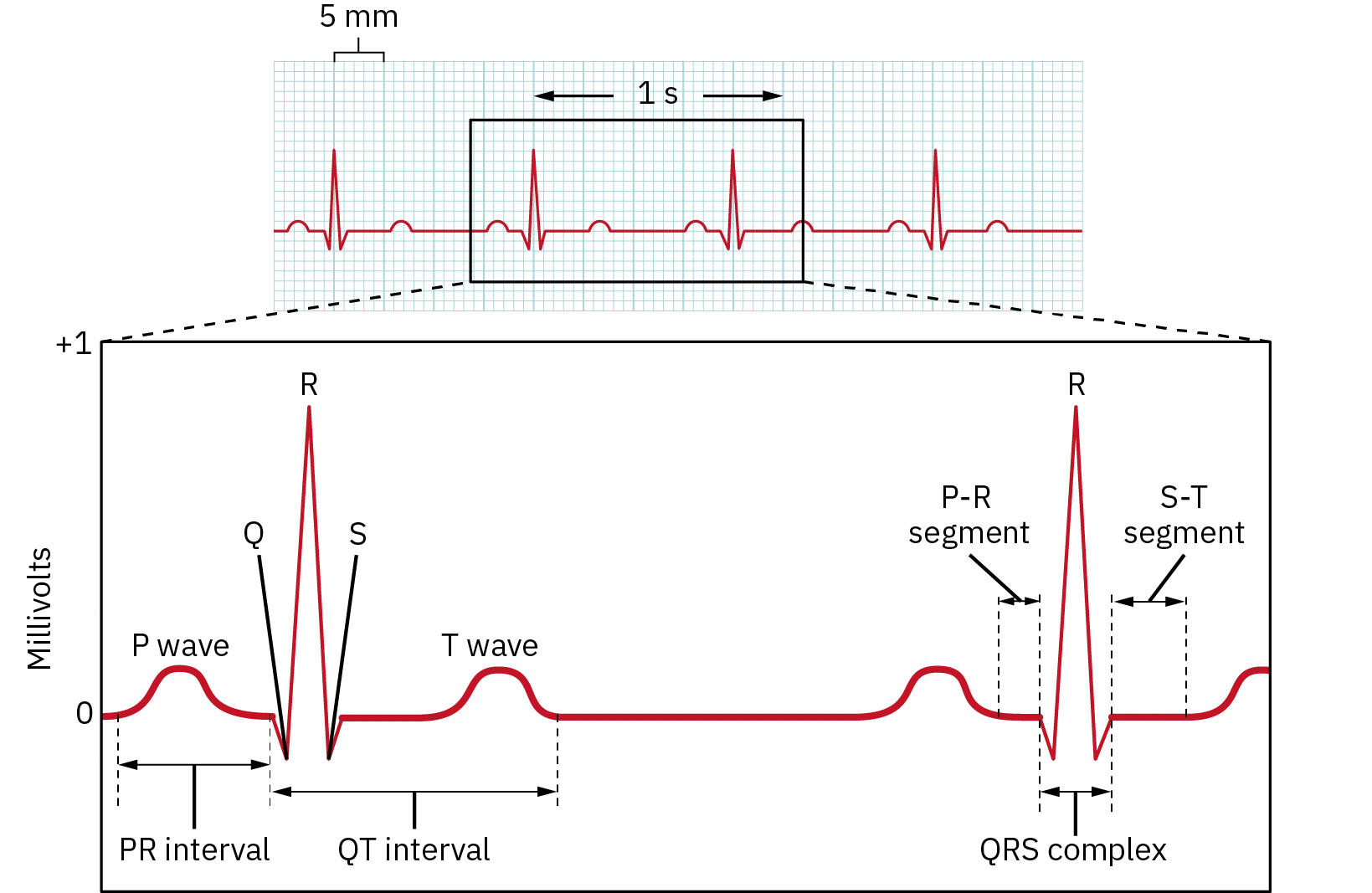 Normal waves from 1 second of an EKG are shown, consisting of the P wave, T wave, P-R and S-T segment, the PR and QT interval and the QRS complex.