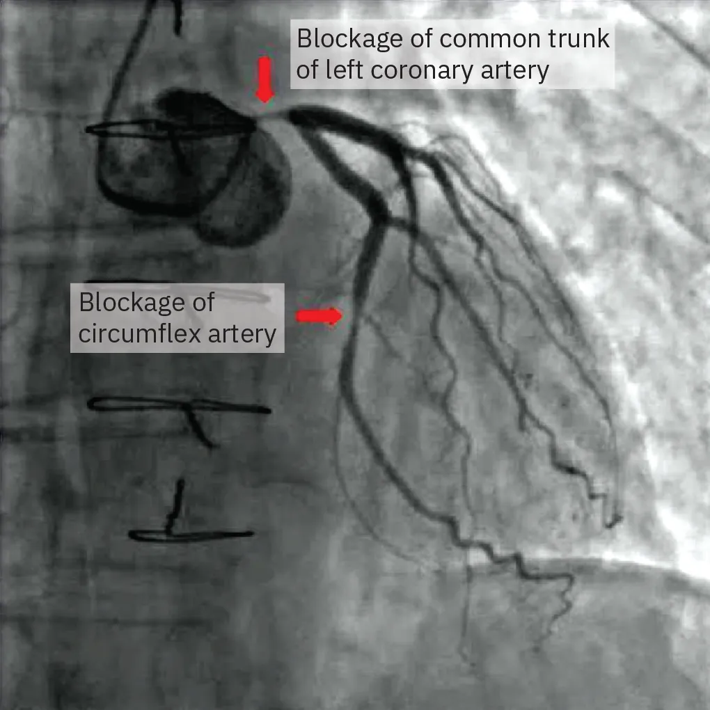 An x ray shows blockage in the left coronary artery and the circumflex artery.