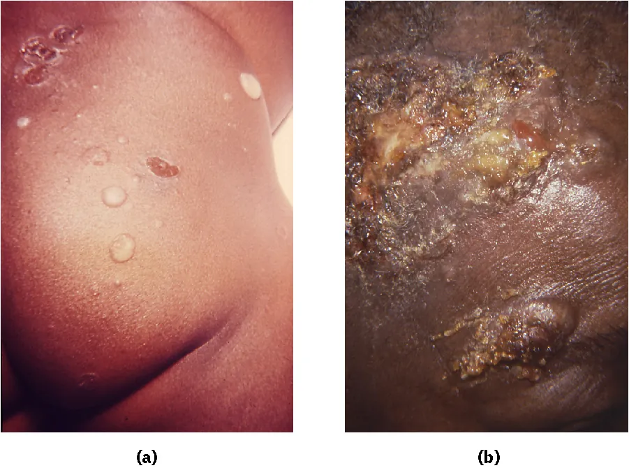 Photo of (a) Bullous impetigo leaking clear liquid and (b) non Bullous impetigo with a yellow crust.