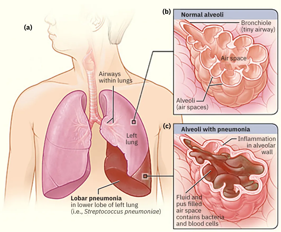 Diagram showing (a) pneumonia causing inflammation in lungs, labeling airways within lungs, left lung, lobar pneumonia in lower lobe of left lung (i.e., Streptococcus pneumoniae); (b) normal alveoli, labeling bronchiole (tiny airway), airspace, alveoli (air spaces); (c) alveoli with pneumonia, labeling inflammation in alveolar wall, fluid and pus filled air space contains bacteria and blood cells.