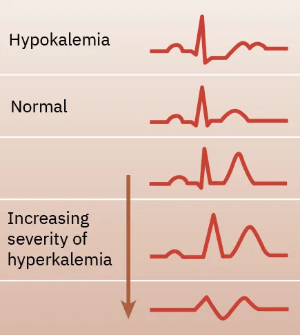 A color graphic showing how different potassium levels produce widening PR intervals, longer QRS duration, and peaked T waves.