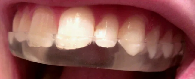 Teeth with bite guard.