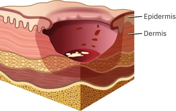 Stage 3 pressure injury showing necrotic tissue and epibole.