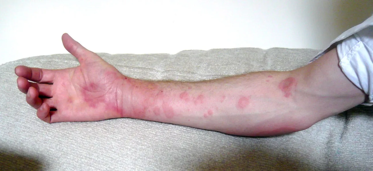 Photo of individual’s inner arm covered with pink wheals, in varying shapes and sizes, from bicep to palm.