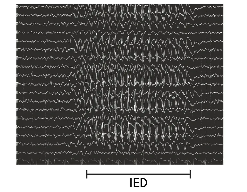 EG tracings showing that Interictal epileptiform discharges (IED) show up via EEG as a generalized 3 Hz signal.