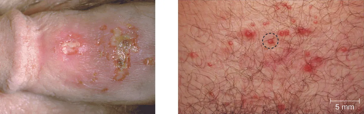 Photo of penis with white sored. B) Photo of skin with red raised bumps.