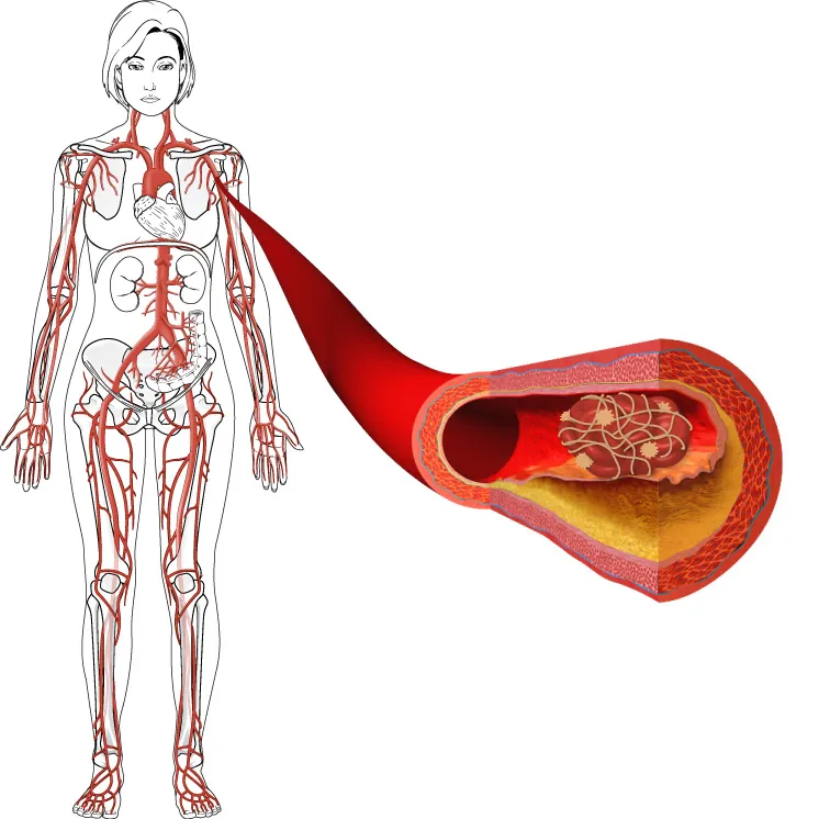 A diagram depicts the human body with a focus on the extensive blood vessel system, showcasing circulation pathways and a blood clot.