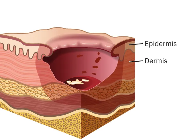 Stage 3 pressure injury showing necrotic tissue and epibole.