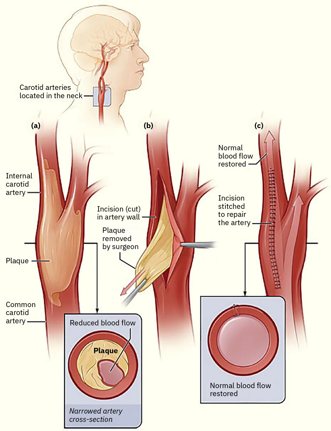 Diagram showing CEA, labeling Carotid arteries located in neck, Internal carotid artery, Plaque, Common carotid artery, Incision (cut) in artery wall, Plaque removed by surgeon, Normal blood flow restored, Incision stitched to repair the artery, Narrowed artery cross-section showing reduced blood flow and plaque, Normal blood flow restored.