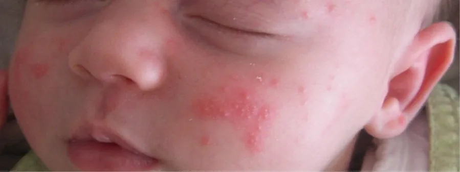Photo of newborn with baby acne.