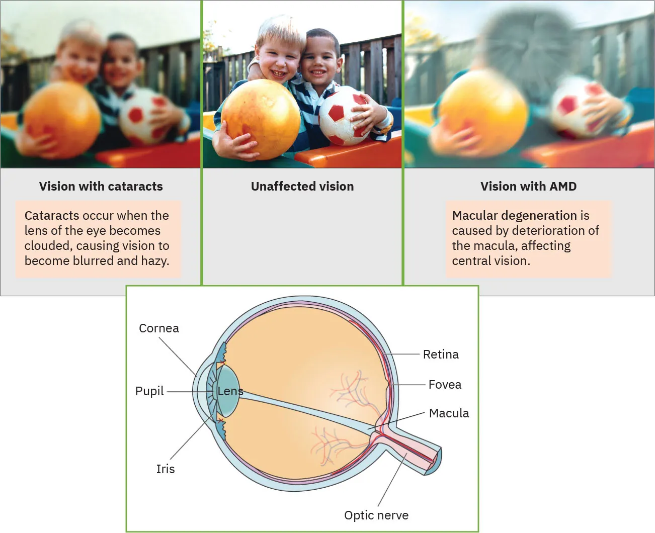 Photos showing vision with cataracts (cloudy image), Unaffected vision (clear image), and Vision with AMD image (middle of image is obscured; rest is blurry) . Illustration of eyeball with parts labeled is visible.