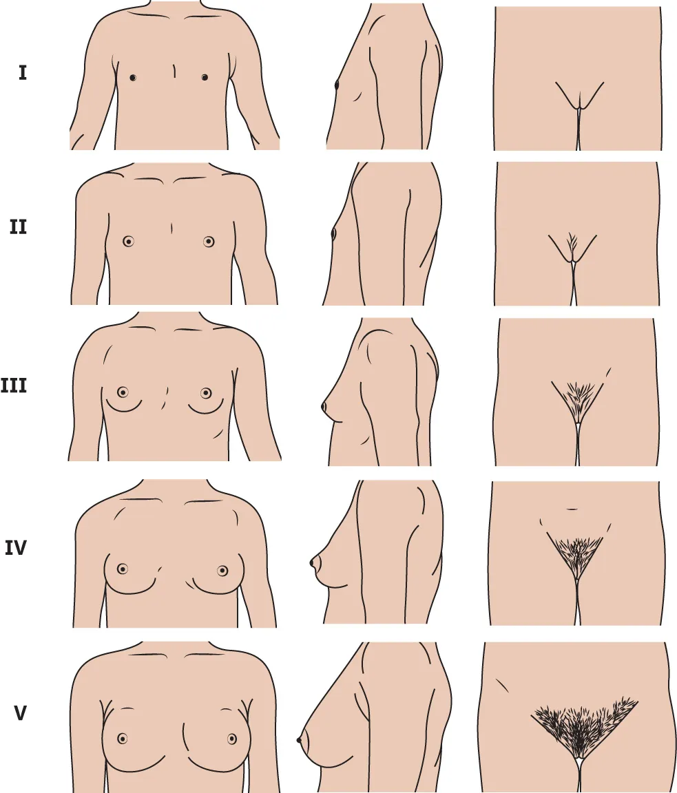 Tanner stages: I: prepubertal, II: breast buds, some pubic hair, III: breast enlarged, more pubic hair, IV: larger breast, adult pubic hair, V: mature breast, pubic hair extends to upper thigh.