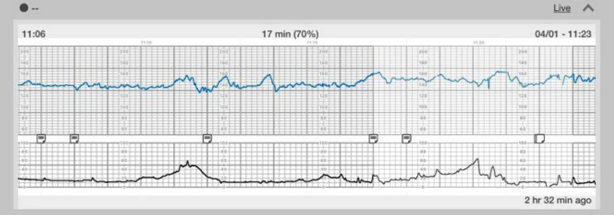Fetal heart rate reading showing accelerations, moderate variability, no decelerations, and uterine contractions suggesting early labor.