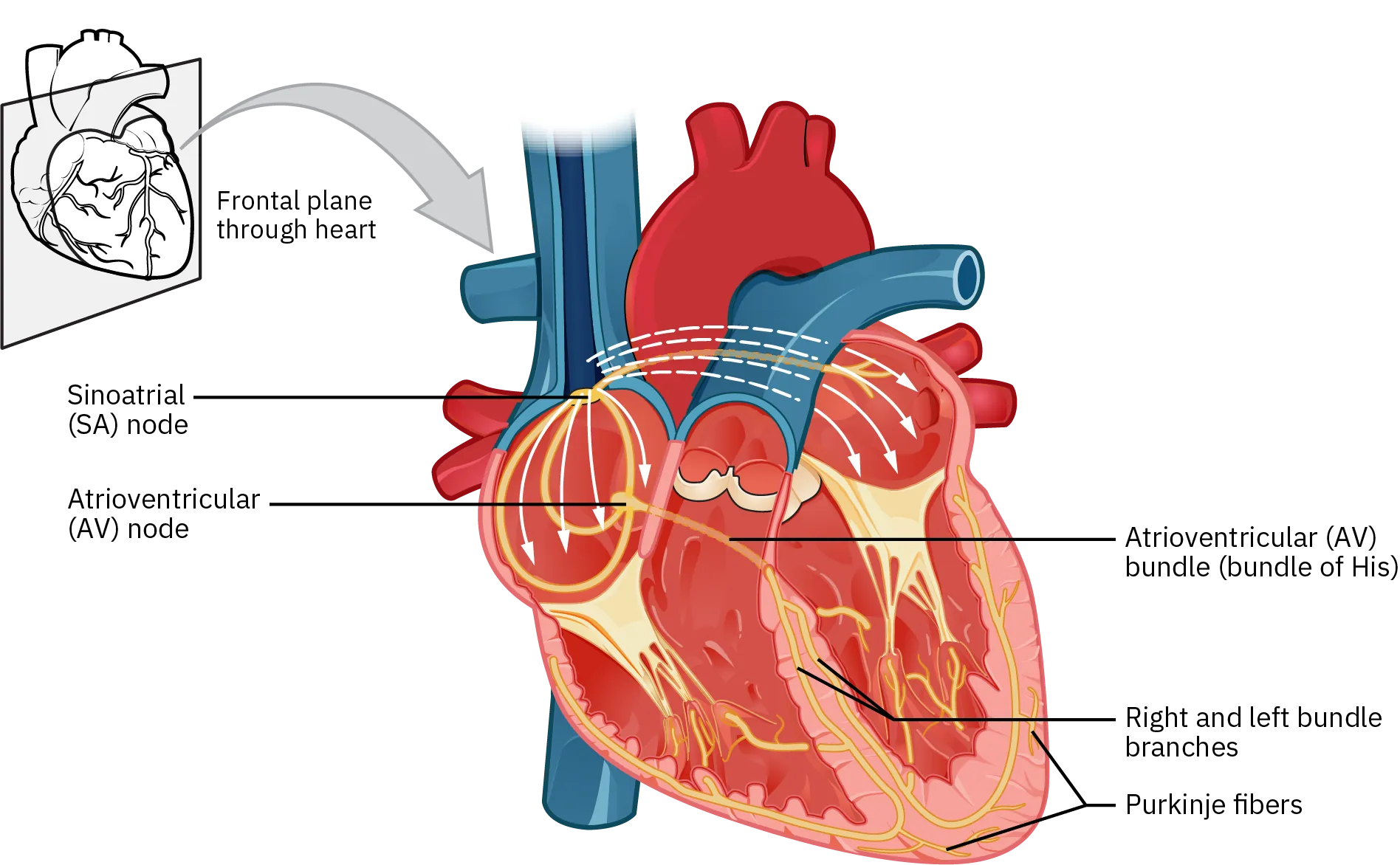 The path of electrical impulses through the heart is shown.