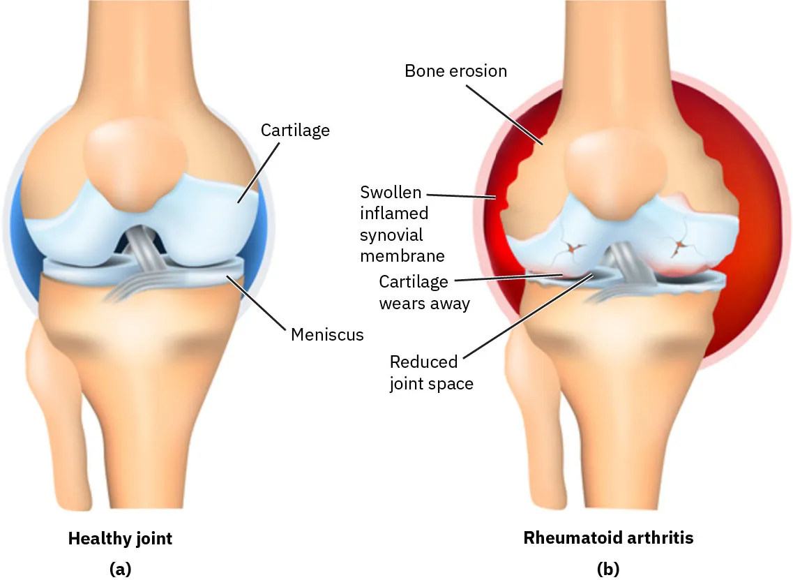 The image compares a healthy knee joint to one affected by rheumatoid arthritis. The left side shows a healthy joint with intact cartilage and meniscus. The right side illustrates a joint with rheumatoid arthritis, showing bone erosion, a swollen inflamed synovial membrane, cartilage wear, and reduced joint space. Each component is clearly labeled.
