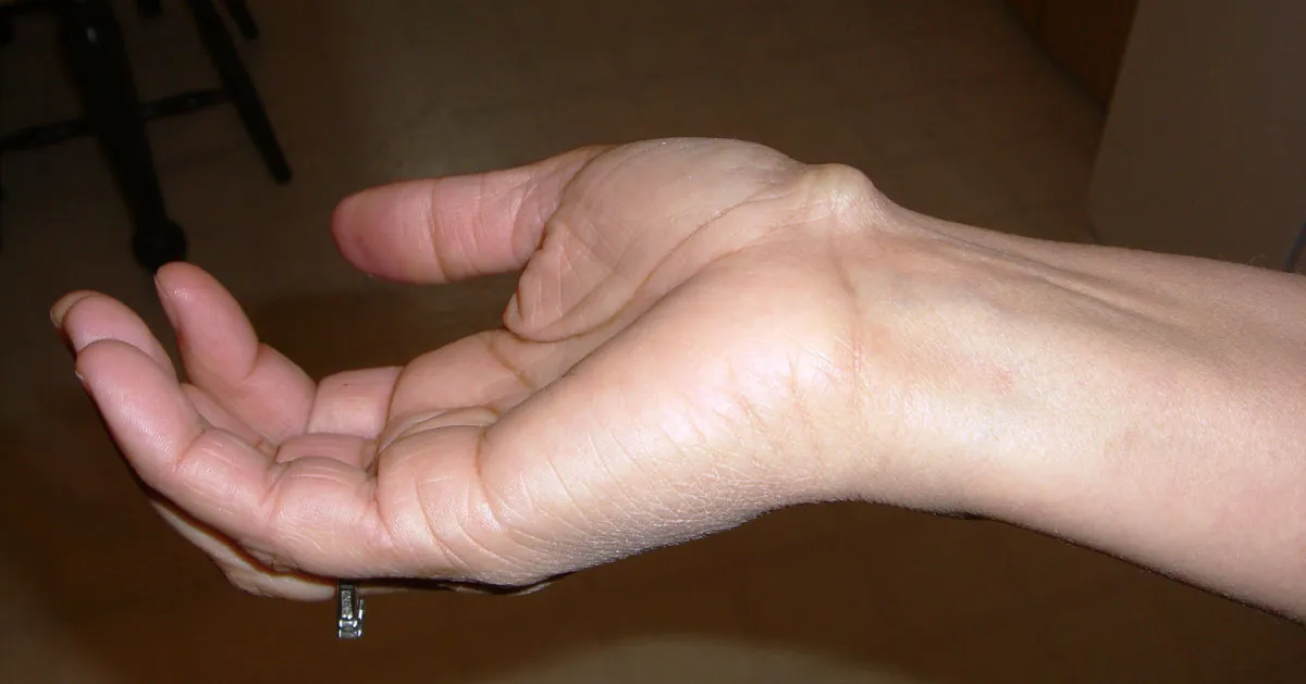 The image is a close-up of a person's wrist showing a prominent swelling, which is indicative of a ganglion cyst. The cyst appears on the back of the wrist, against an indoor background.