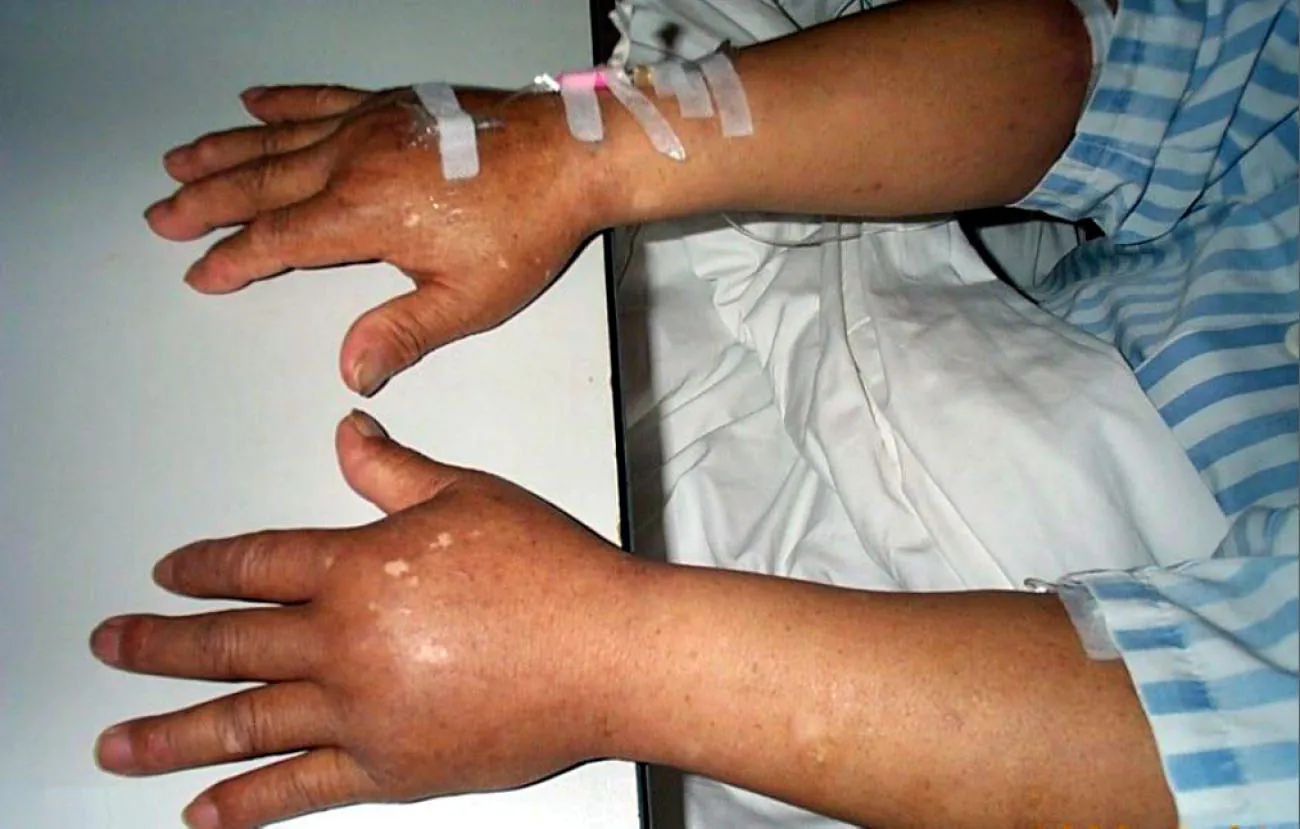 A photograph shows a patient’s two hands. Both hands are swollen.