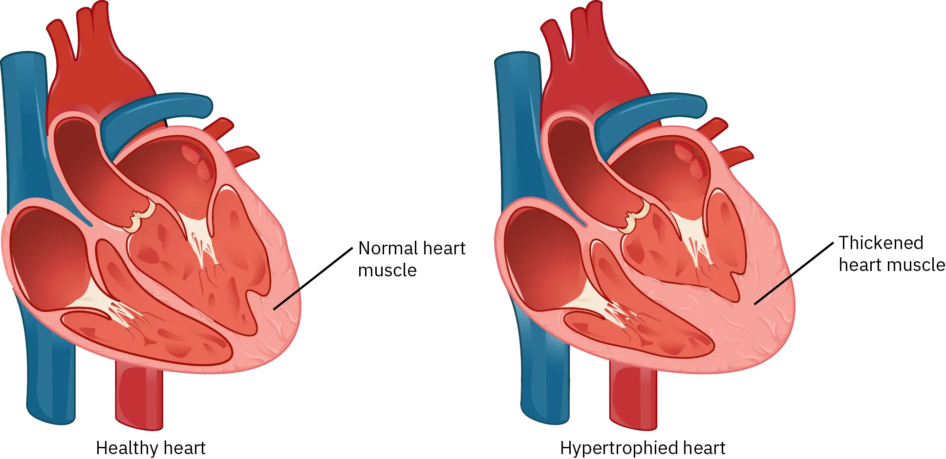 Two diagrams of the heart muscle are side by side. One shows a healthy heart and the other shows a hypertrophied heart. The healthy heart has a normal heart muscle; the hypertrophied heart has a thickened heart muscle.