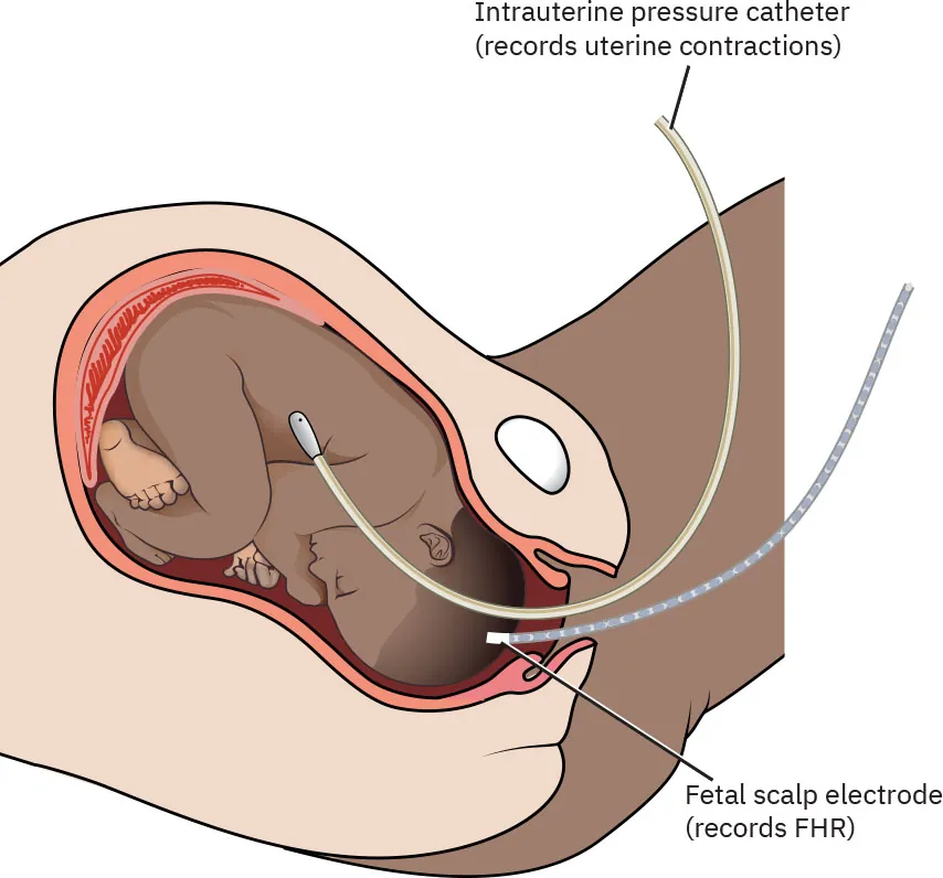 Diagram showing placements of components of internal fetal monitoring system: intrauterine pressure catheter (records uterine contractions) and fetal scalp electrode (records FHR).