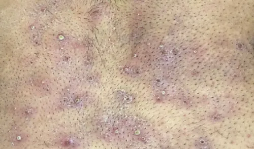 Close-up view of skin displaying numerous inflamed pustules and papules scattered across an area with stubble, indicating a widespread inflammatory skin condition like folliculitis or acne.