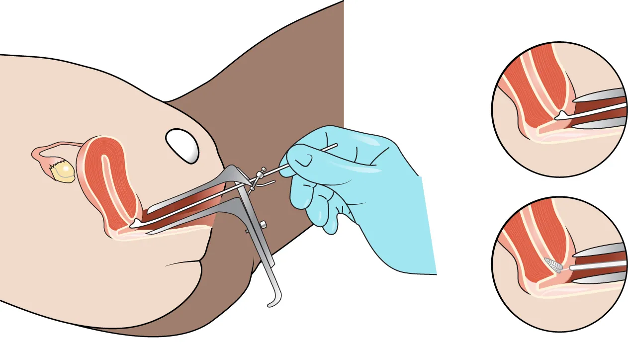 Images of speculum being inserted into vagina to collect cells from uterus.