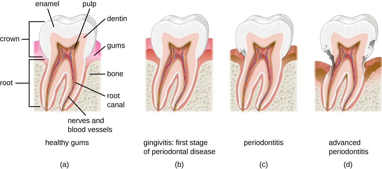 Diagram of a tooth with healthy gums. The crown is the part above the gums, the root is the part below the gums. The enamel is the outer layer, inside is the dentin and inside that is the pulp which contains the root canal, nerves, and blood vessels. Below the gums is bone. Gingivitis is the first stage of periodontal disease. This is when the gums become darker red and swollen. Periodontitis the gumsrecede and the enamel begins to break. In advanced periodontitis the gums recede even further and the tooth degenerates past the enamel and into the dentin and pulp.
