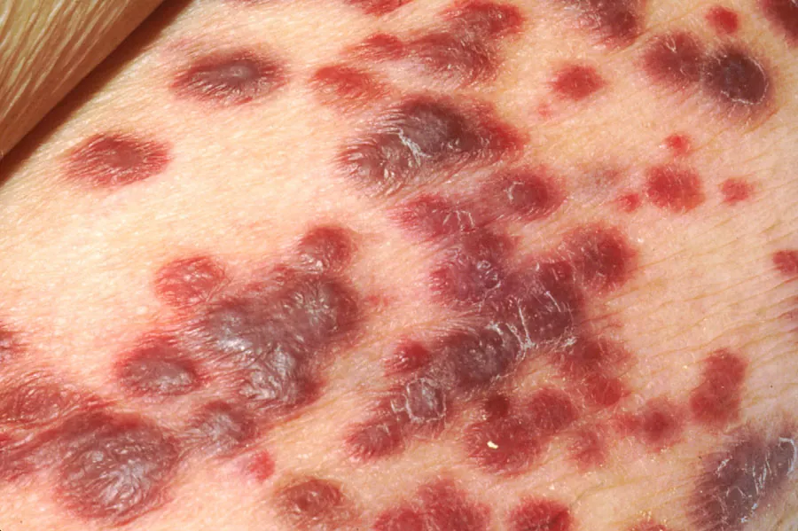 Kaposi’s sarcoma on the skin of an AIDS patient.