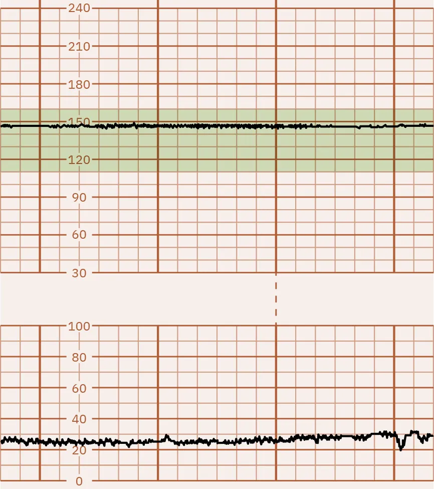 Fetal heart rate reading indicating absent variability.
