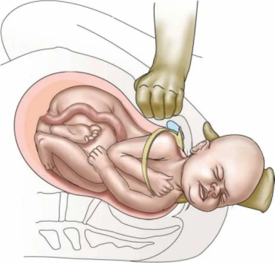 Image of hand being pressed down on birthing person’s abdomen over fetus’ shoulder during delivery.