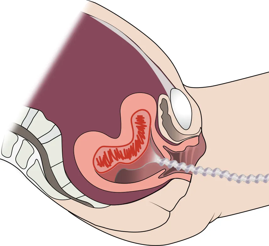 Image of the uterus turning inside out and coming out of the vagina.