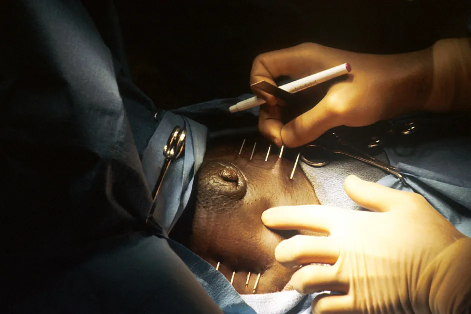 Healthcare provider administering radioactive seeds to patient