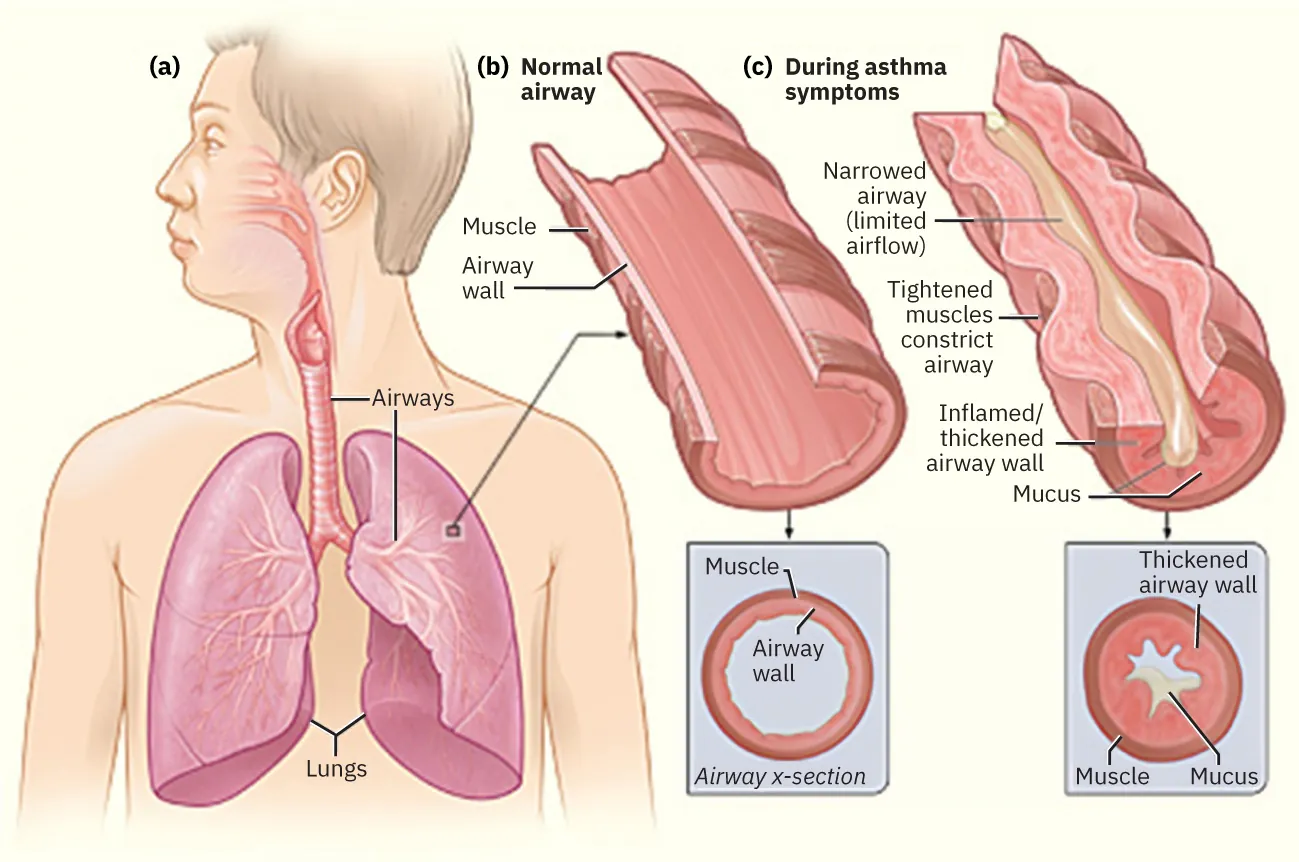 Diagram showing lungs with asthma (a) lungs, airways, (b) normal airway, muscle, airway wall, airway x-section; (c) during asthma symptoms, narrowed airway (limited air flow), tightened muscles constrict airway, inflamed/thickened airway wall, airway x-section.