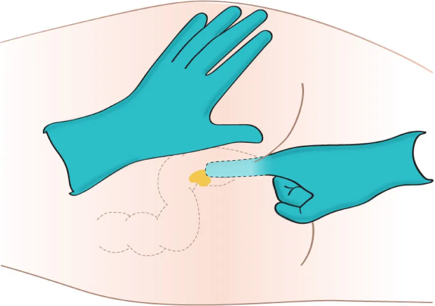 An illustration of a nurse inserting a suppository into a patient’s rectum using their finger.
