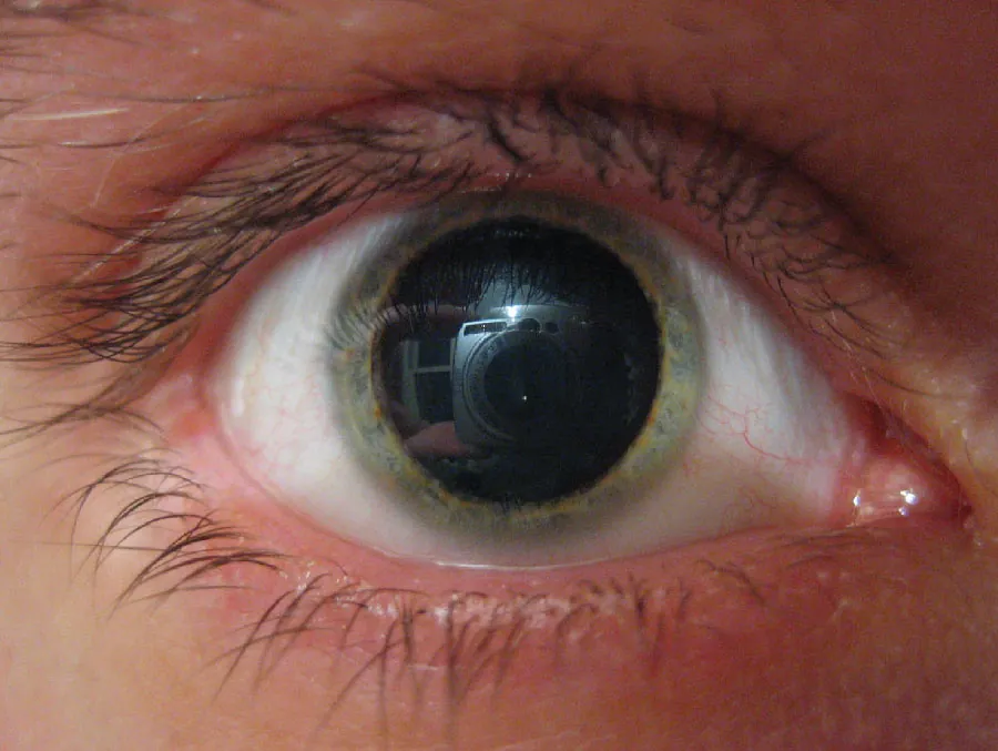 An eye with a dilated pupil due to mydriasis.
