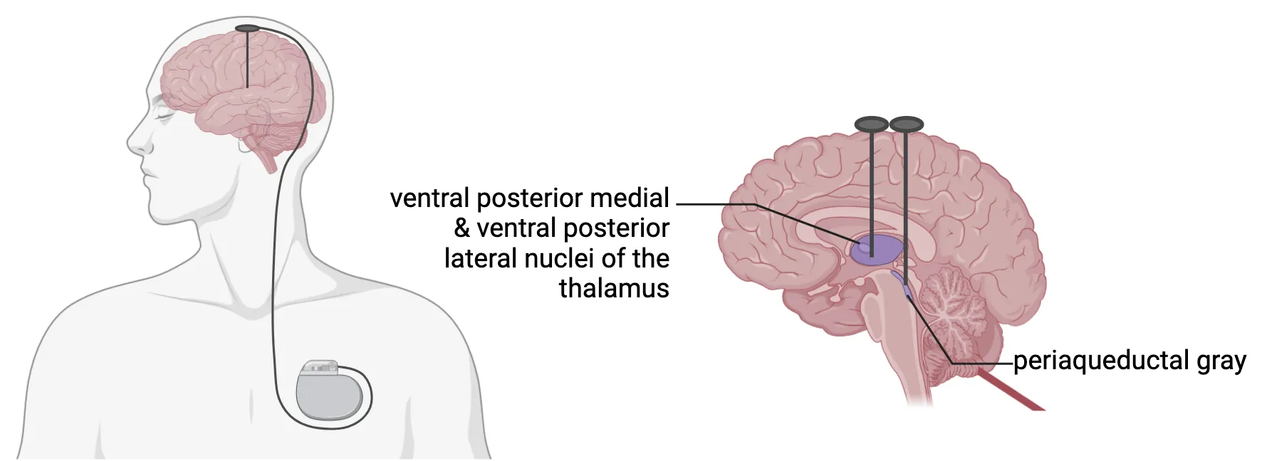 Left: diagram of human head/torso with DBS generator shown in chest and wires extending on top of head, connecting to a wire the penetrates into the brain. Right: Midline sagittal section of human brain showing DBS wires targeting 2 different brain nuclei.