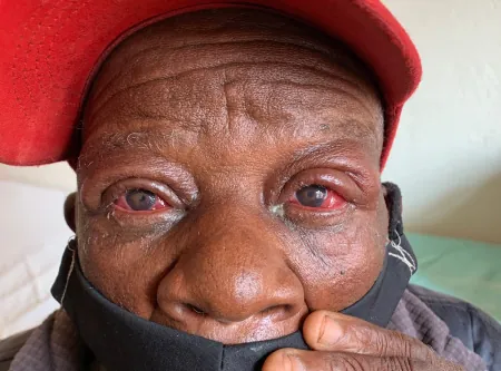 A photograph of a man’s face with trachoma of the eyes. The eyes are very red and swollen.