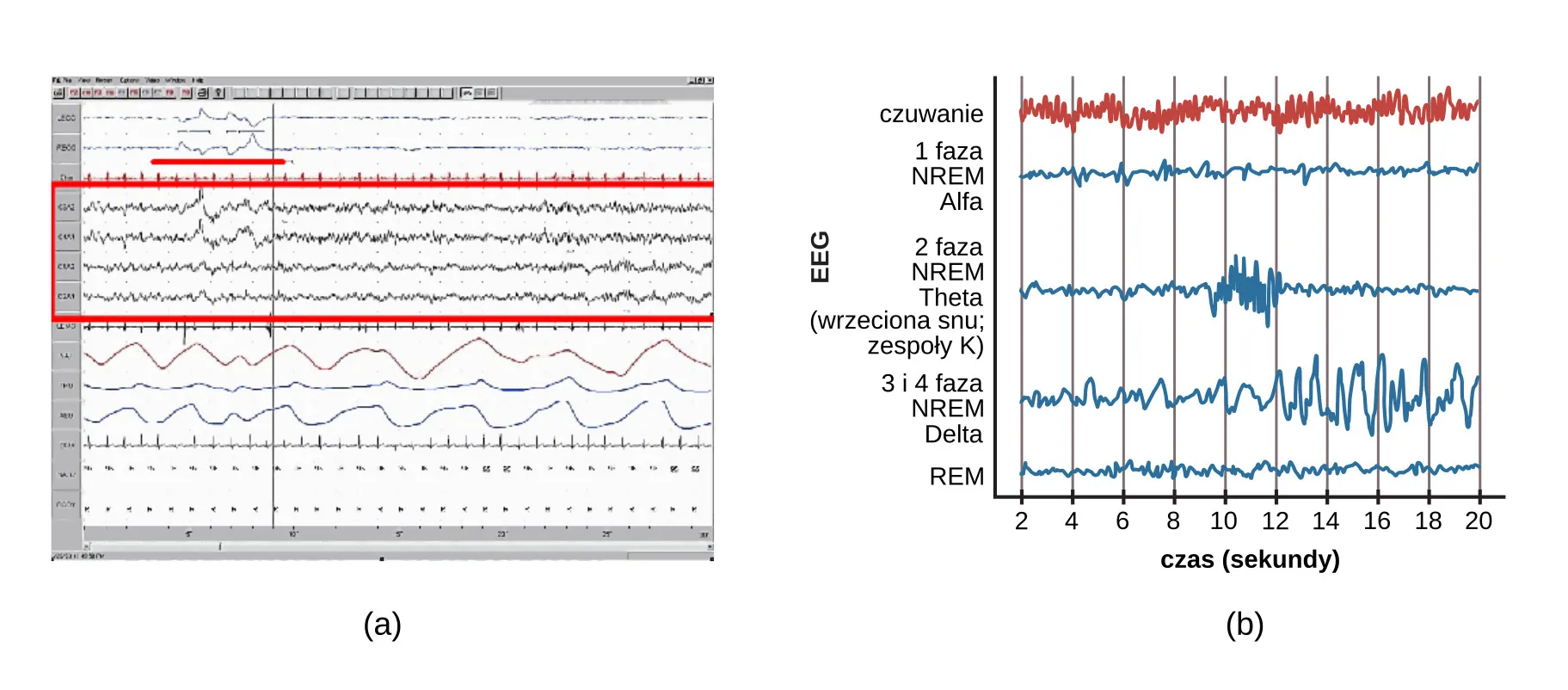 Chart A is a polysonograph with the period of rapid eye movement (REM) highlighted.Chart b is a shows brainwaves at various stages of sleep, with the “awake” stage highlighted to show its similarity to the wave pattern of “REM” in part A.