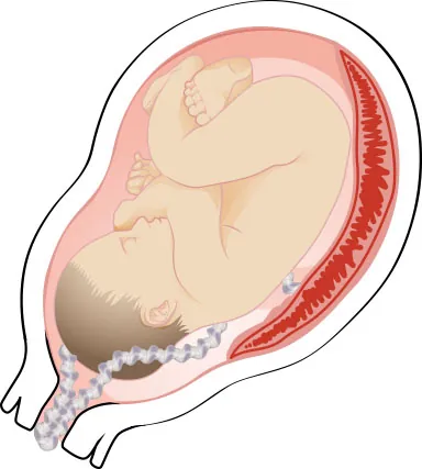 Image of umbilical cord present in birthing canal before fetus is delivered.