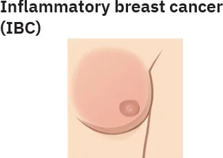 Image of swollen and red breast.