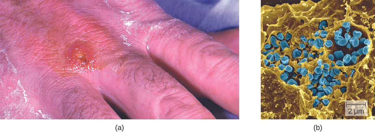 a) photo of a red blister on a hand. B) micrograph of circular cells.