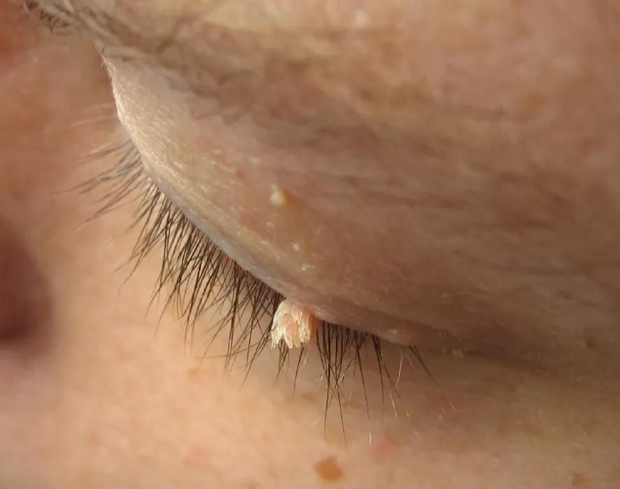 A closeup photo of an eyelid with a wart on it. The wart is a small cluster of rough looking skin.