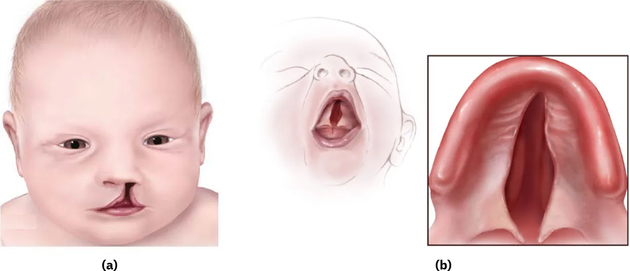 Part (a) shows an illustration of an infant with a unilateral cleft lip; part (b) depicts an infant with a unilateral cleft palate, visibly affecting the mouth and nasal area.