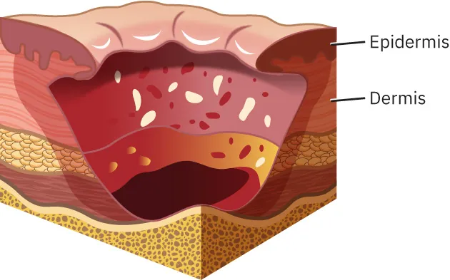 Stage IV pressure injury extending to the bone.
