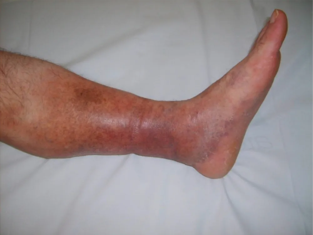 A close-up of a person’s leg shows significant swelling and bruising on the foot, suggesting deep vein thrombosis.