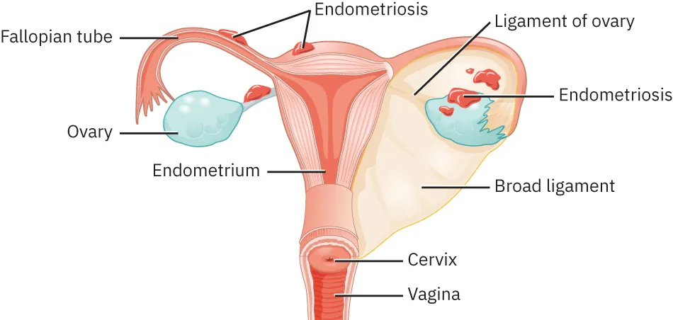 Image of uterus with endometriosis present by fallopian tubes, ovaries, and top of uterus. Parts labeled: Fallopian tubes, ovary, endometrium, ligament of ovary, broad ligament, cervix, and vagina.