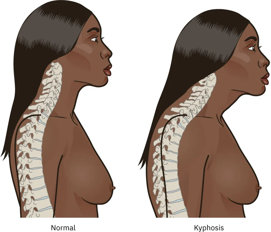 Image of person with normal spine and one with kyphosis (curved spine).